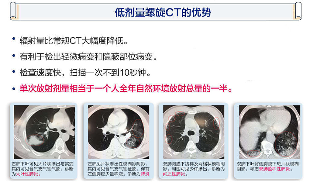 肺部螺旋CT检查